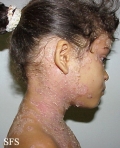 pemphigus foliaceus-localized form