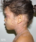 pemphigus foliaceus-localized form
