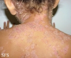 pemphigus foliaceus-localized form