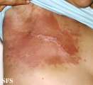 carcinoma erysipeloides