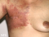 carcinoma erysipeloides
