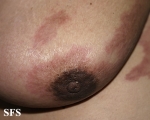 carcinoma erysipeloides