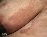 carcinoma erysipeloides