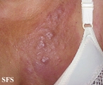 carcinoma erysipeloides