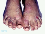 epidermolysis bullosa simplex