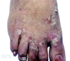 epidermolysis bullosa simplex