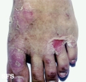 epidermolysis bullosa simplex