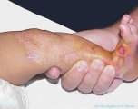 epidermolysis bullosa simplex