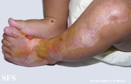epidermolysis bullosa simplex