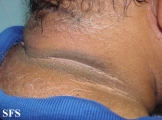 pseudo-acanthosis nigricans