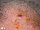 squamous cell carcinoma