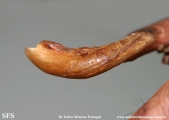 onychogryphosis