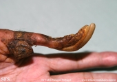 onychogryphosis
