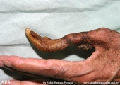 onychogryphosis