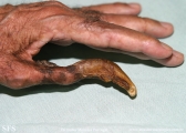 onychogryphosis