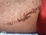 keratoacanthoma-linear epidermal nevus