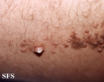 keratoacanthoma-linear epidermal nevus