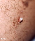 keratoacanthoma-linear epidermal nevus