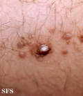 keratoacanthoma-linear epidermal nevus