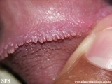pearly penile papules