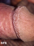 pearly penile papules
