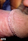 pearly penile papules
