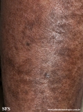 mycosis_fungoides_with_focal_cd30-positive_large_cell_transformation