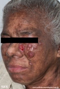 mycosis_fungoides_with_focal_cd30-positive_large_cell_transformation