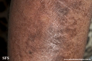 mycosis_fungoides_with_focal_cd30-positive_large_cell_transformation