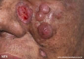 mycosis_fungoides_with_focal_cd30-positive_large_cell_transformation