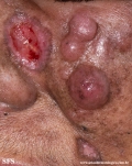 mycosis_fungoides_with_focal_cd30-positive_large_cell_transformation