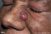 mycosis_fungoides_with_focal_cd30-positive_large_cell_transformation
