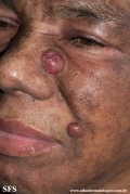 mycosis_fungoides_with_focal_cd30-positive_large_cell_transformation