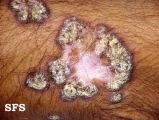 lupus erythematosus chronicus verrucous
