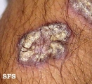 lupus erythematosus chronicus verrucous