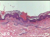 porokeratosis-segmental porokeratosis