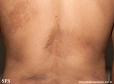 atrofoderma of pasini and pierini