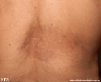 atrofoderma of pasini and pierini