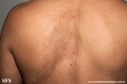 atrofoderma of pasini and pierini