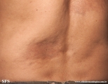 atrofoderma of pasini and pierini