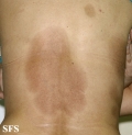 atrofoderma of pasini and pierini