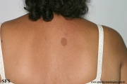 atrofoderma of pasini and pierini