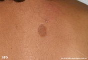 atrofoderma of pasini and pierini