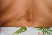 atrofoderma of pasini and pierini