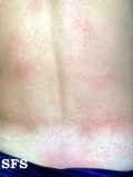 dengue