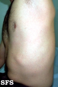 dengue