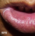 syphilis secondary