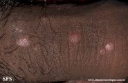 syphilis secondary