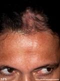 scleroderma-frontoparietal_morphoea
