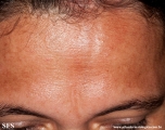 scleroderma-frontoparietal_morphoea